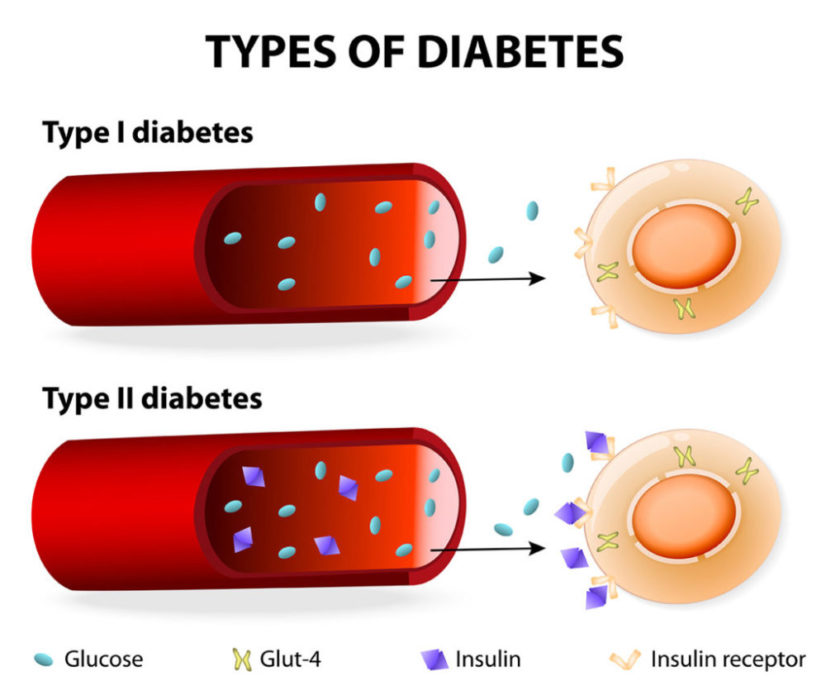 diabetes-types